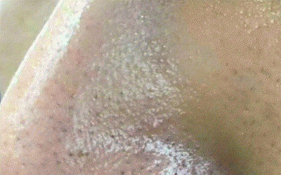 鹤叔推荐的护肤大法:十滴水+甲硝唑凝胶去黑头 鹤叔推荐的护肤大法:十滴水+甲硝唑凝胶去黑头
